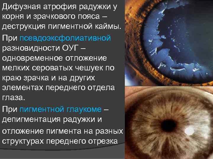 Дифузная атрофия радужки у корня и зрачкового пояса – деструкция пигментной каймы. При псевдоэксфолиативной