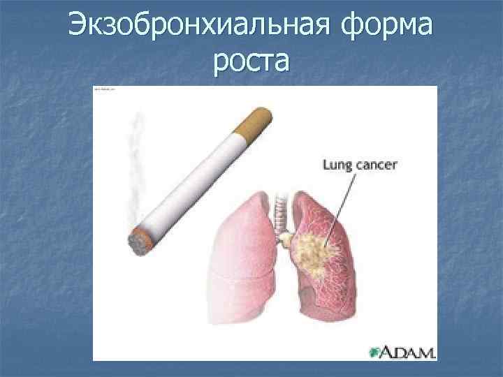 Экзобронхиальная форма роста 