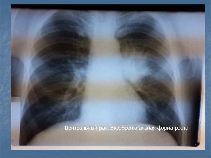 Центральный рак. Экзобронхиальная форма роста 