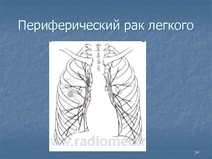Периферический рак легкого 34 