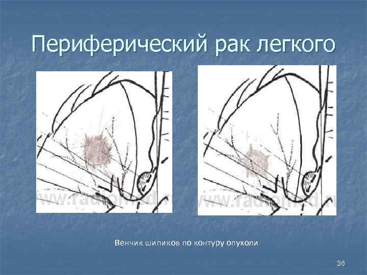 Периферический рак легкого Венчик шипиков по контуру опухоли 36 