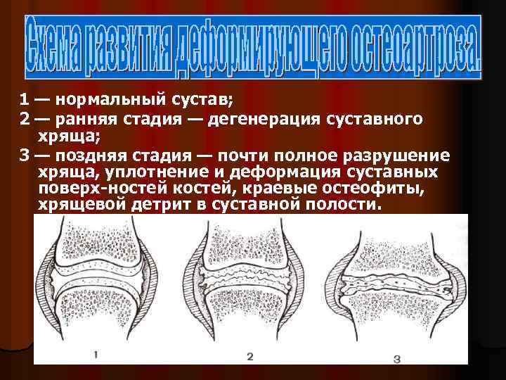1 — нормальный сустав; 2 — ранняя стадия — дегенерация суставного хряща; 3 —