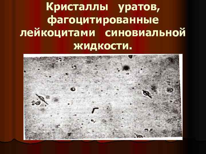  Кристаллы уратов, фагоцитированные лейкоцитами синовиальной жидкости. 