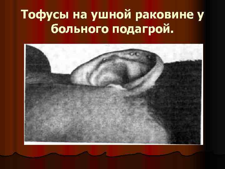 Тофусы на ушной раковине у больного подагрой. 