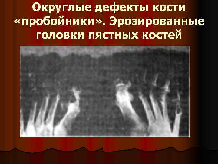  Округлые дефекты кости «пробойники» . Эрозированные головки пястных костей 