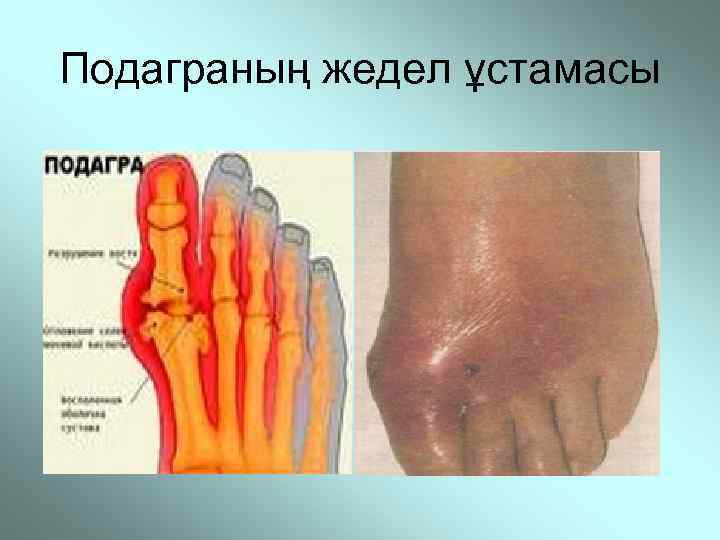 Подаграның жедел ұстамасы 