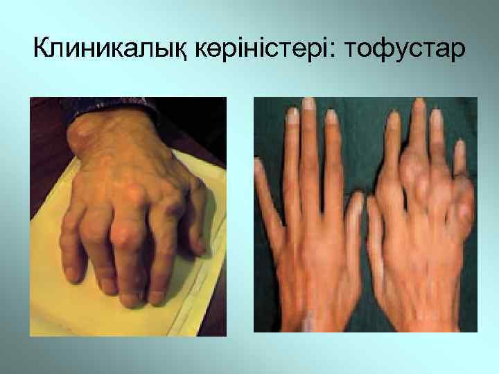 Клиникалық көріністері: тофустар 