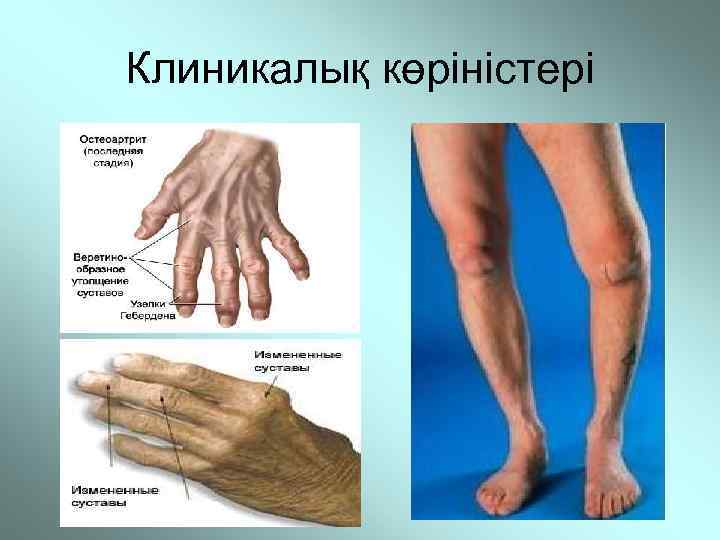 Клиникалық көріністері 