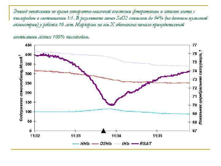 Эпизод гипоксемии во время аппаратно-масочной анестезии фторотаном и закисью азота с кислородом в соотношении