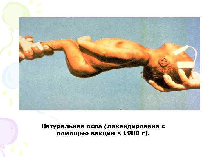 Натуральная оспа (ликвидирована с помощью вакцин в 1980 г). 