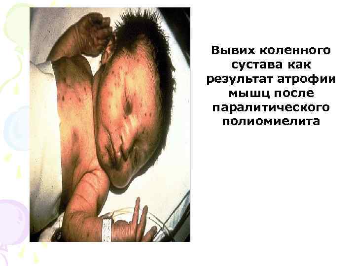 Вывих коленного сустава как результат атрофии мышц после паралитического полиомиелита 