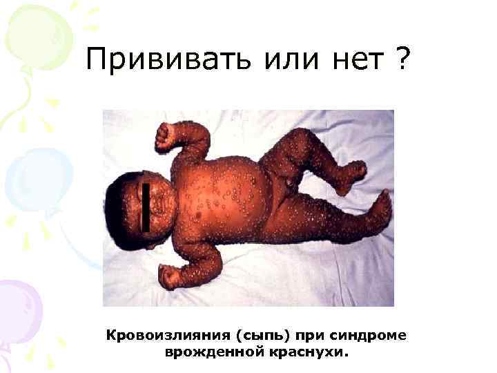 Прививать или нет ? Кровоизлияния (сыпь) при синдроме врожденной краснухи. 