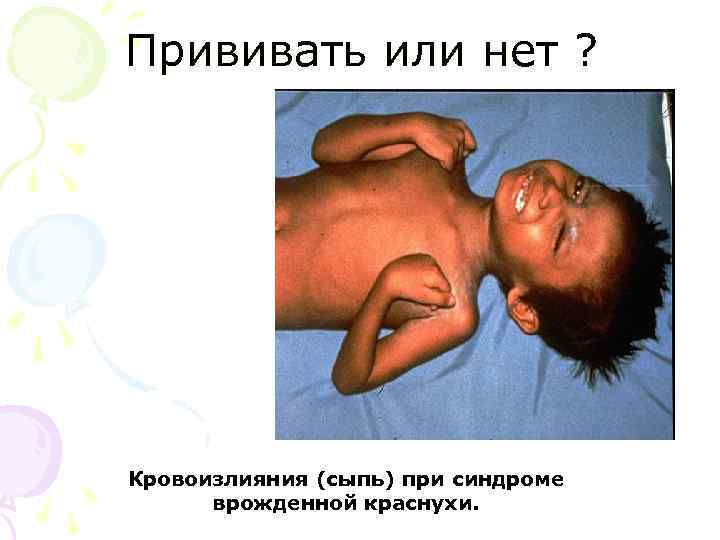 Прививать или нет ? Кровоизлияния (сыпь) при синдроме врожденной краснухи. 