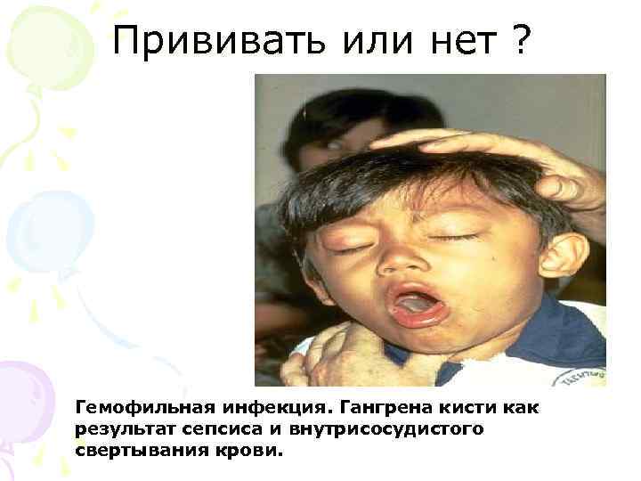 Прививать или нет ? Гемофильная инфекция. Гангрена кисти как результат сепсиса и внутрисосудистого свертывания