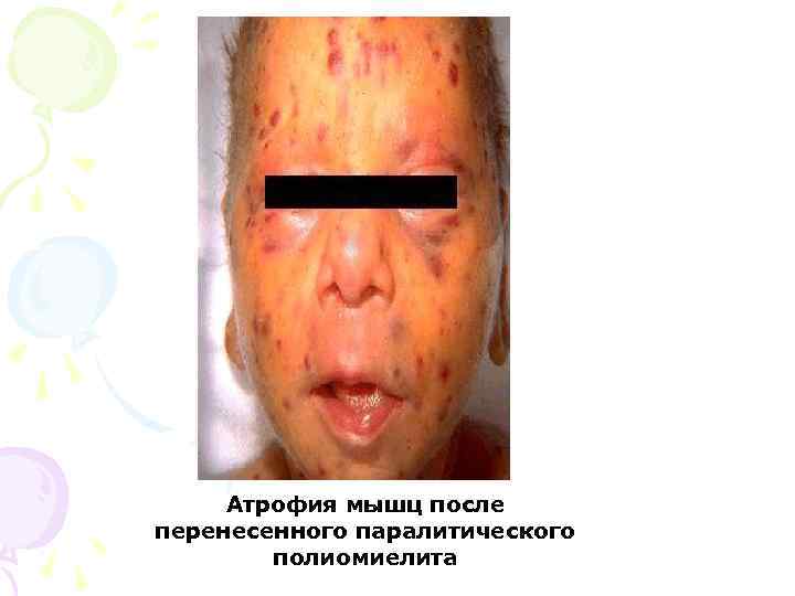 Атрофия мышц после перенесенного паралитического полиомиелита 