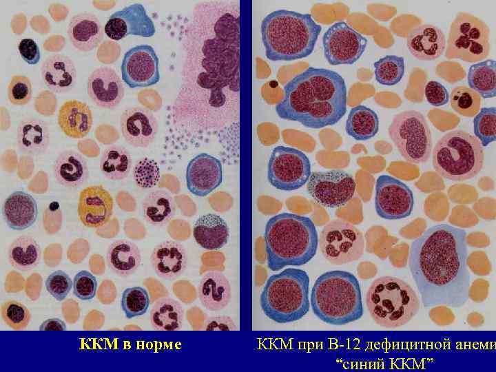 ККМ в норме ККМ при В-12 дефицитной анеми “синий ККМ” 