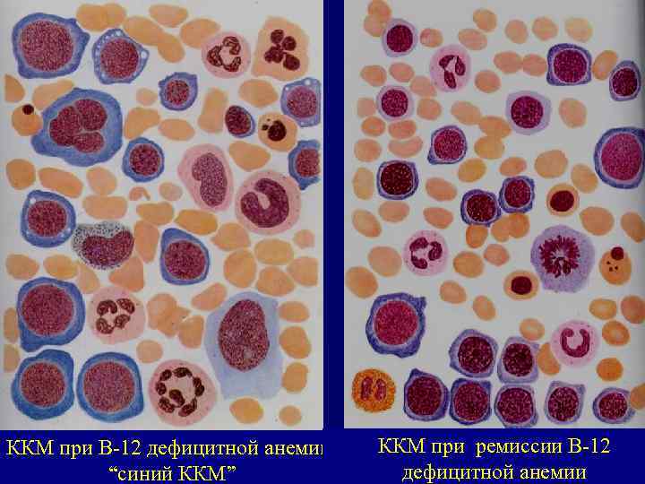 ККМ при В-12 дефицитной анемии “синий ККМ” ККМ при ремиссии В-12 дефицитной анемии 