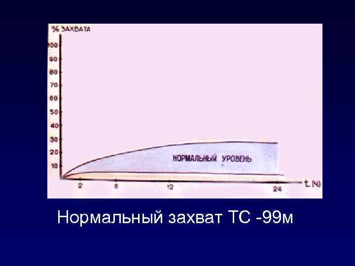 Нормальный захват ТС -99 м 