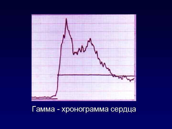 Гамма - хронограмма сердца 