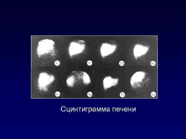 Сцинтиграмма печени 