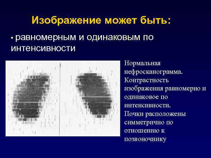 Изображение может быть: • равномерным и одинаковым по интенсивности Нормальная нефросканограмма. Контрастность изображения равномерно