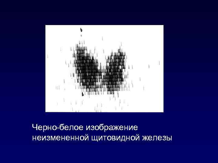 Черно-белое изображение неизмененной щитовидной железы 