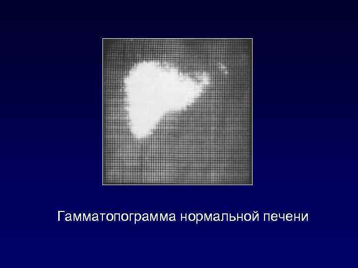 Гамматопограмма нормальной печени 