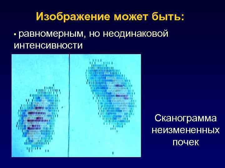 Изображение может быть: • равномерным, но неодинаковой интенсивности Сканограмма неизмененных почек 