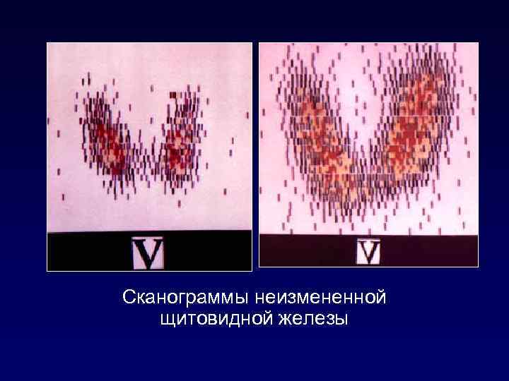 Сканограммы неизмененной щитовидной железы 