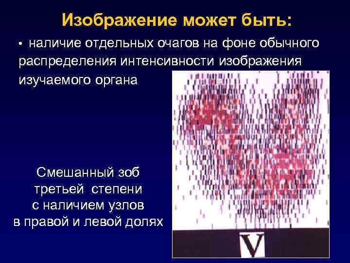 Изображение может быть: • наличие отдельных очагов на фоне обычного распределения интенсивности изображения изучаемого