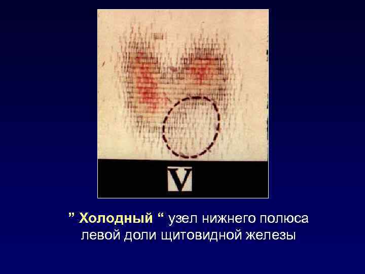 ” Холодный “ узел нижнего полюса левой доли щитовидной железы 