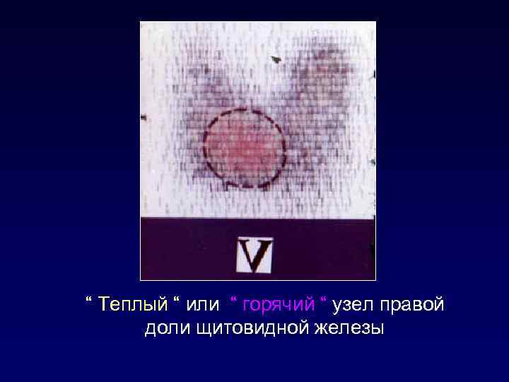 “ Теплый “ или “ горячий “ узел правой доли щитовидной железы 