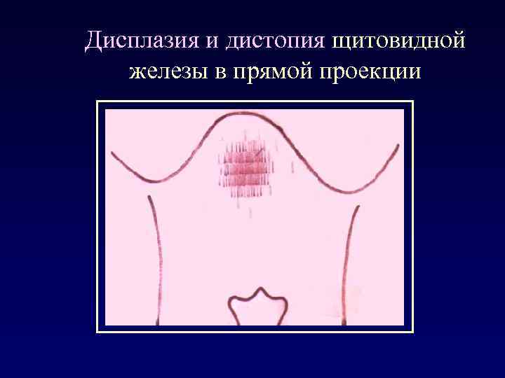 Дисплазия и дистопия щитовидной железы в прямой проекции 