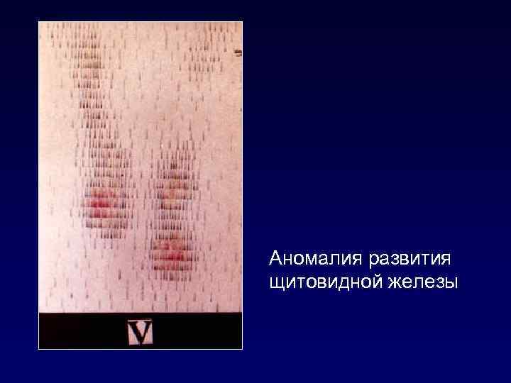 Аномалия развития щитовидной железы 