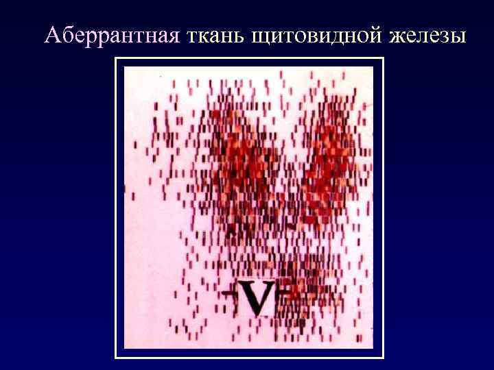 Аберрантная ткань щитовидной железы 
