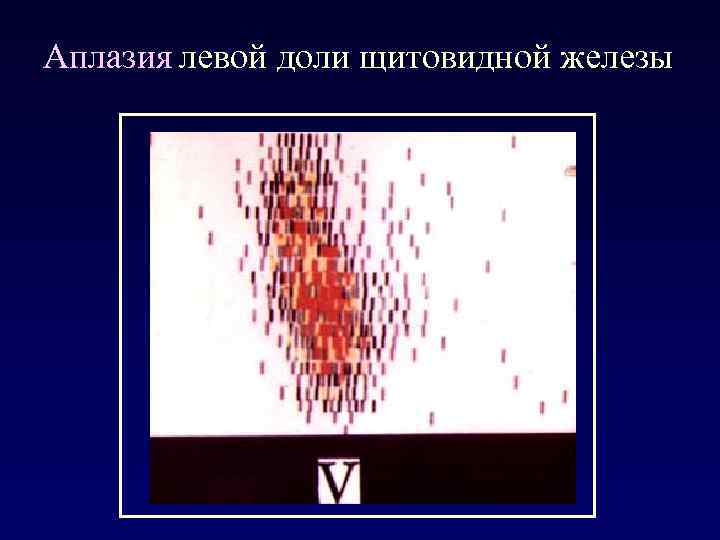 Аплазия левой доли щитовидной железы 