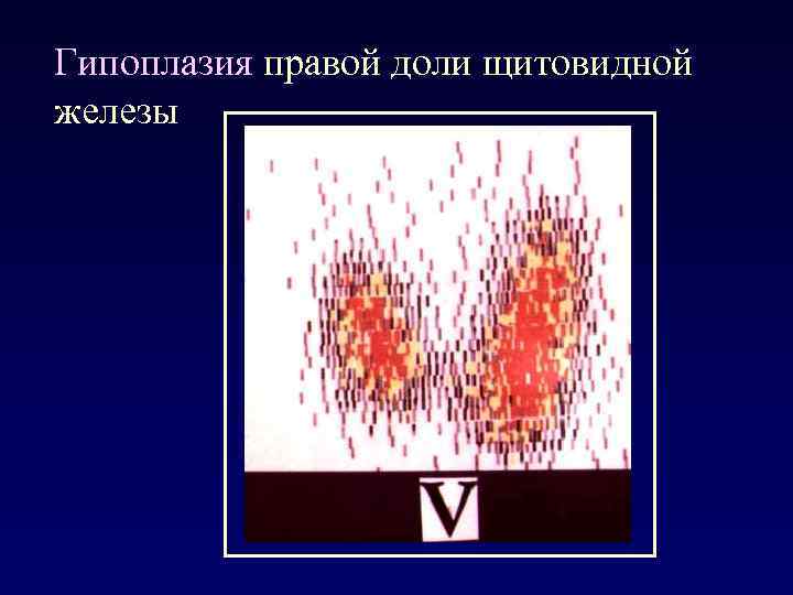 Гипоплазия правой доли щитовидной железы 