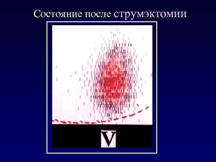 Состояние после струмэктомии 