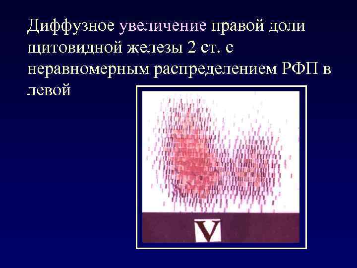 Диффузное увеличение правой доли щитовидной железы 2 ст. с неравномерным распределением РФП в левой
