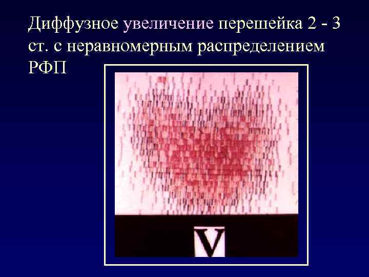 Диффузное увеличение перешейка 2 - 3 ст. с неравномерным распределением РФП 