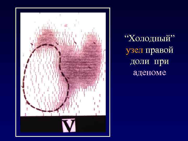 “Холодный” узел правой доли при аденоме 