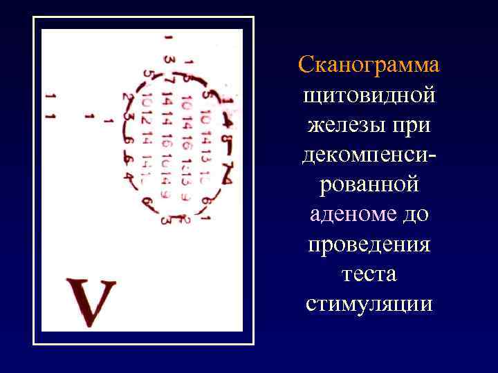 Сканограмма щитовидной железы при декомпенсированной аденоме до проведения теста стимуляции 