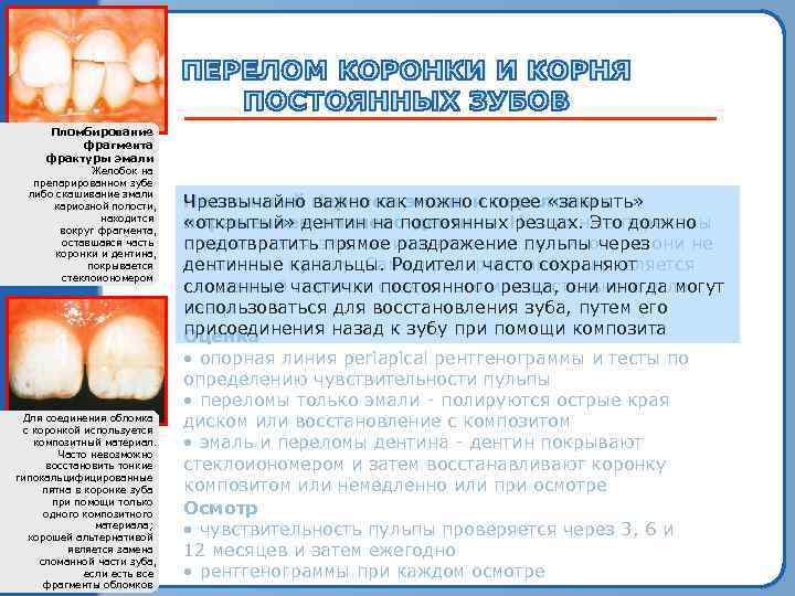 Пломбирование фрагмента фрактуры эмали Желобок на препарированном зубе либо скашивание эмали кариозной полости, находится