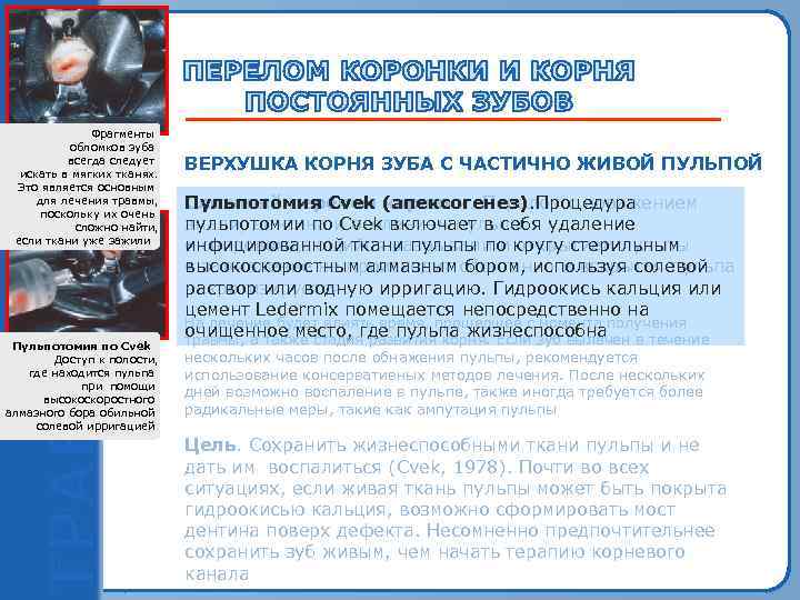 Пульпотомия по Cvek Фрагменты Обнаженный при травме обломков зуба всегда верхний следует центральный резец