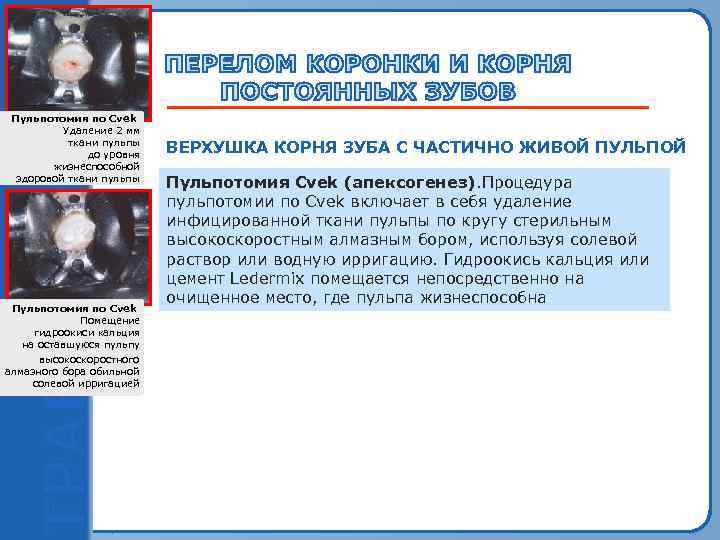 Пульпотомия по Cvek Удаление 2 мм Обнаженный при травме тканиверхний пульпы до уровня центральный