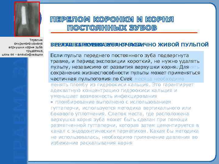 Терапия открытого канала верхушки корня зуба трудоемка, цель ее ‑ апексификации ЗРЕЛАЯ ВЕРХУШКА КОРНЯЧАСТИЧНО