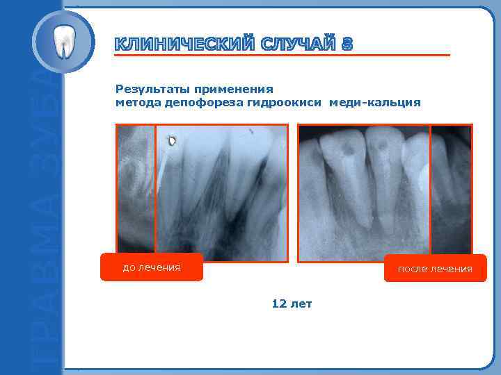 Результаты применения метода депофореза гидроокиси меди-кальция Пробный текст до лечения после лечения 12 лет