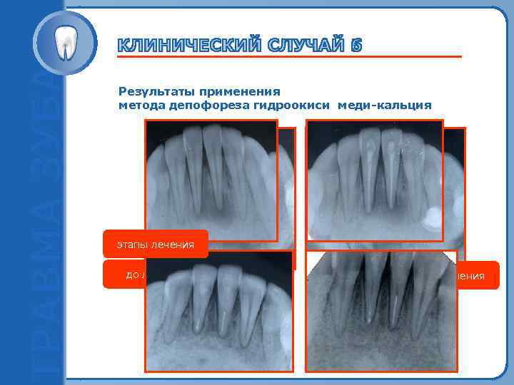 Результаты применения метода депофореза гидроокиси меди-кальция Пробный текст этапы лечения до лечения после лечения