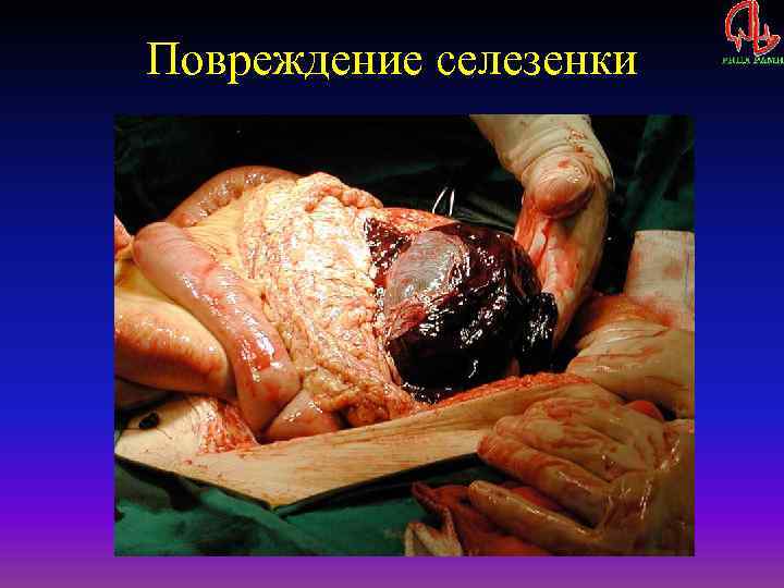 Повреждение селезенки 