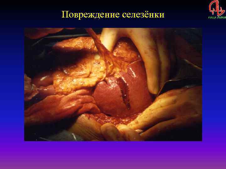 Повреждение селезёнки 